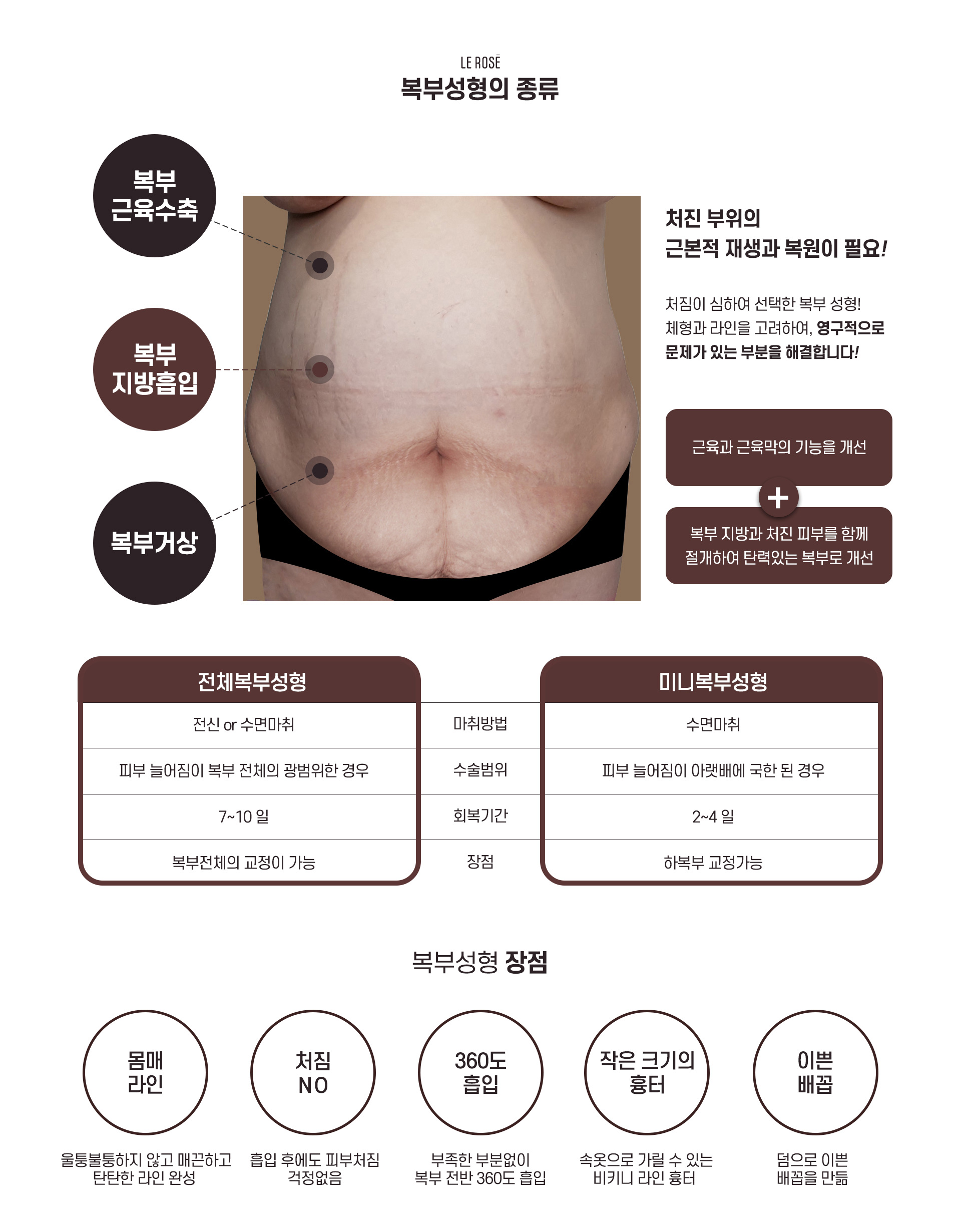 복부거상 종류장점