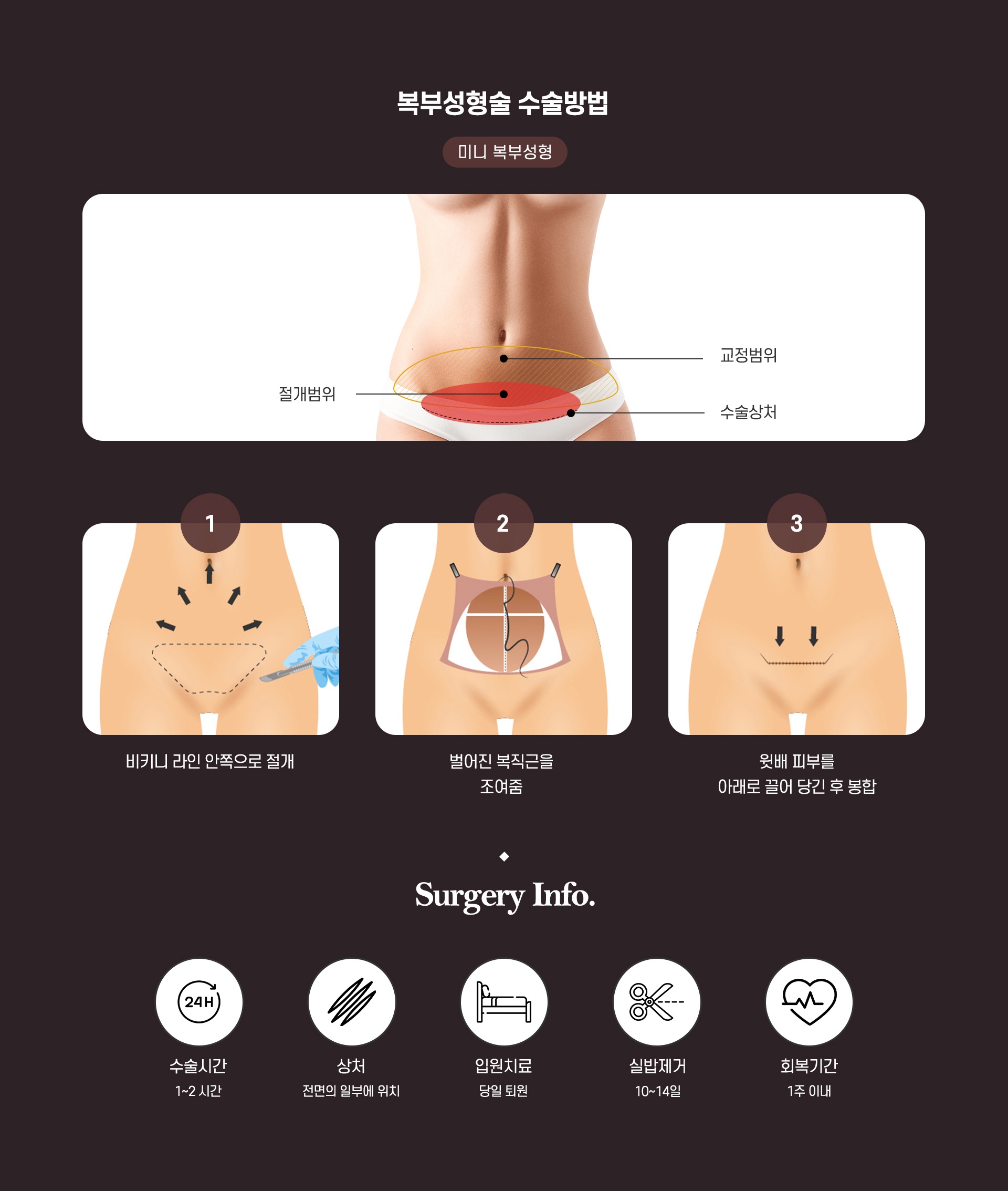 복부거상 수술방법