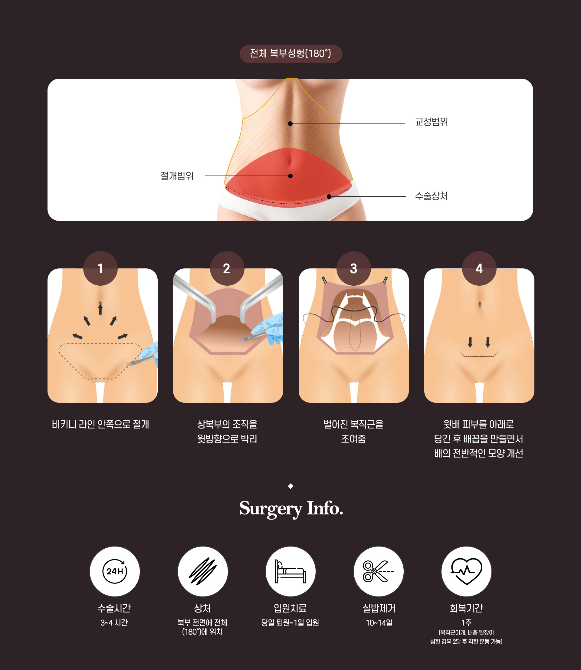 복부거상 수술방법2