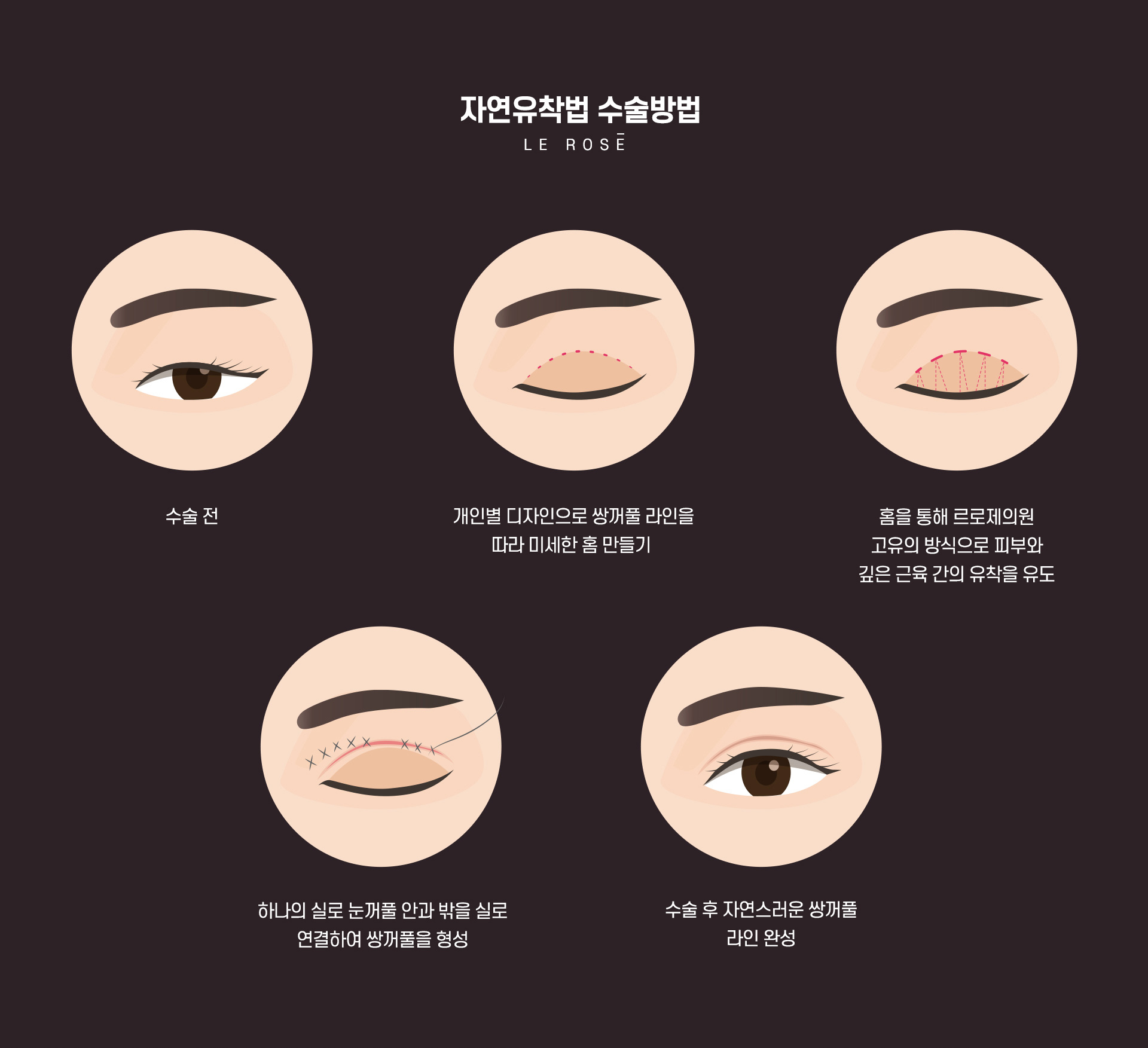 자연유착쌍꺼풀 수술방법