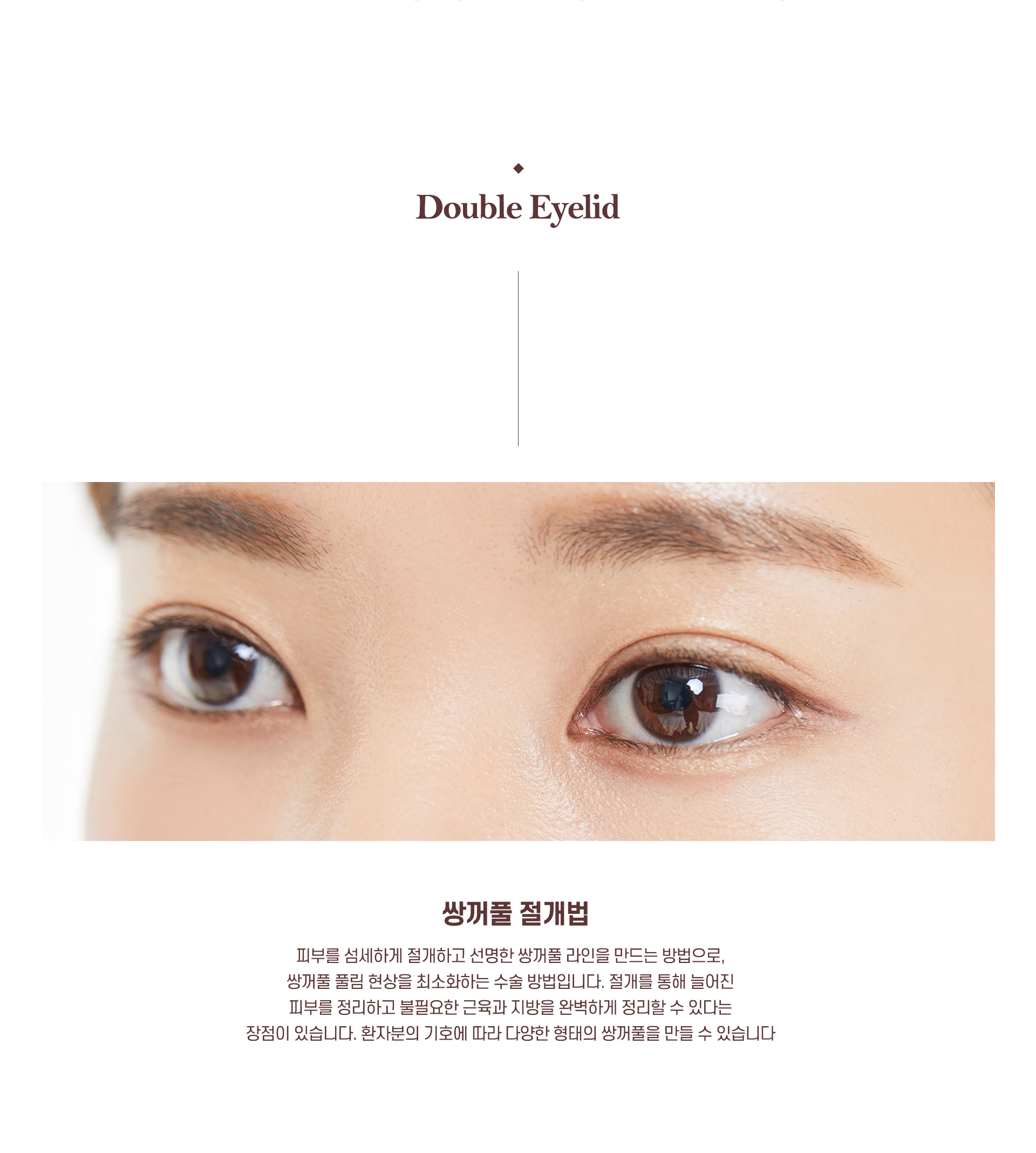 절개쌍꺼풀 정의