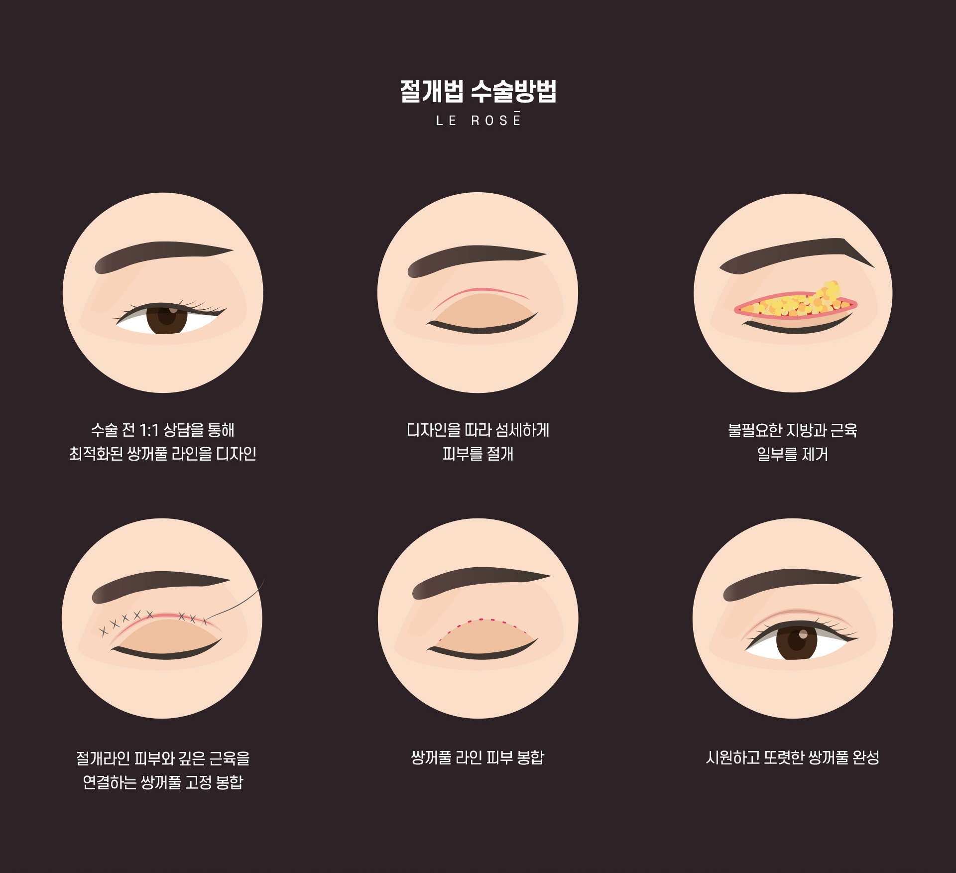 절개쌍꺼풀 수술방법