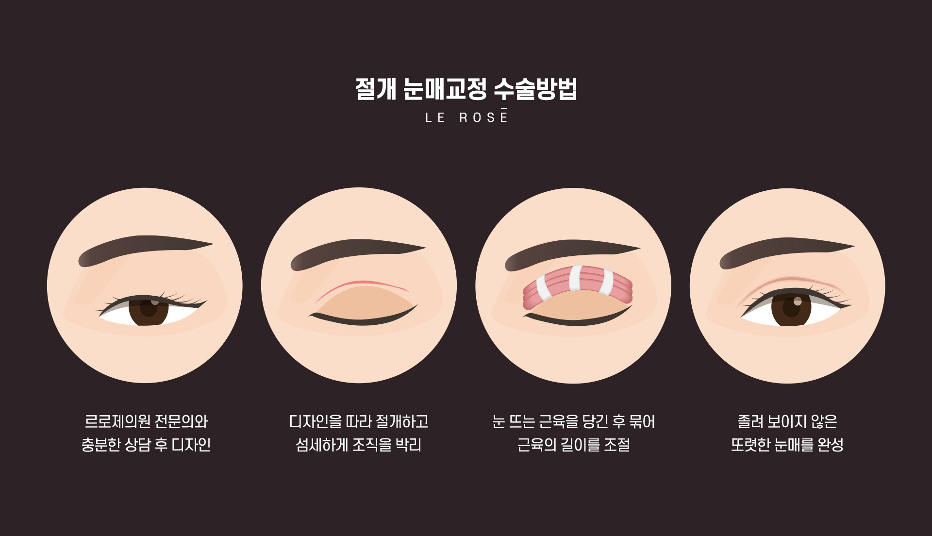 눈매교정 수술방법