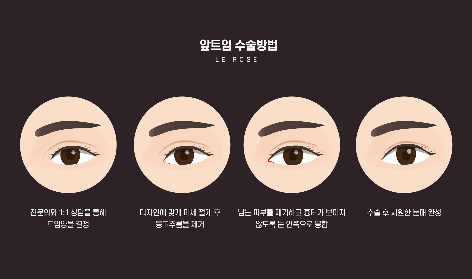 트임성형 앞트임수술방법