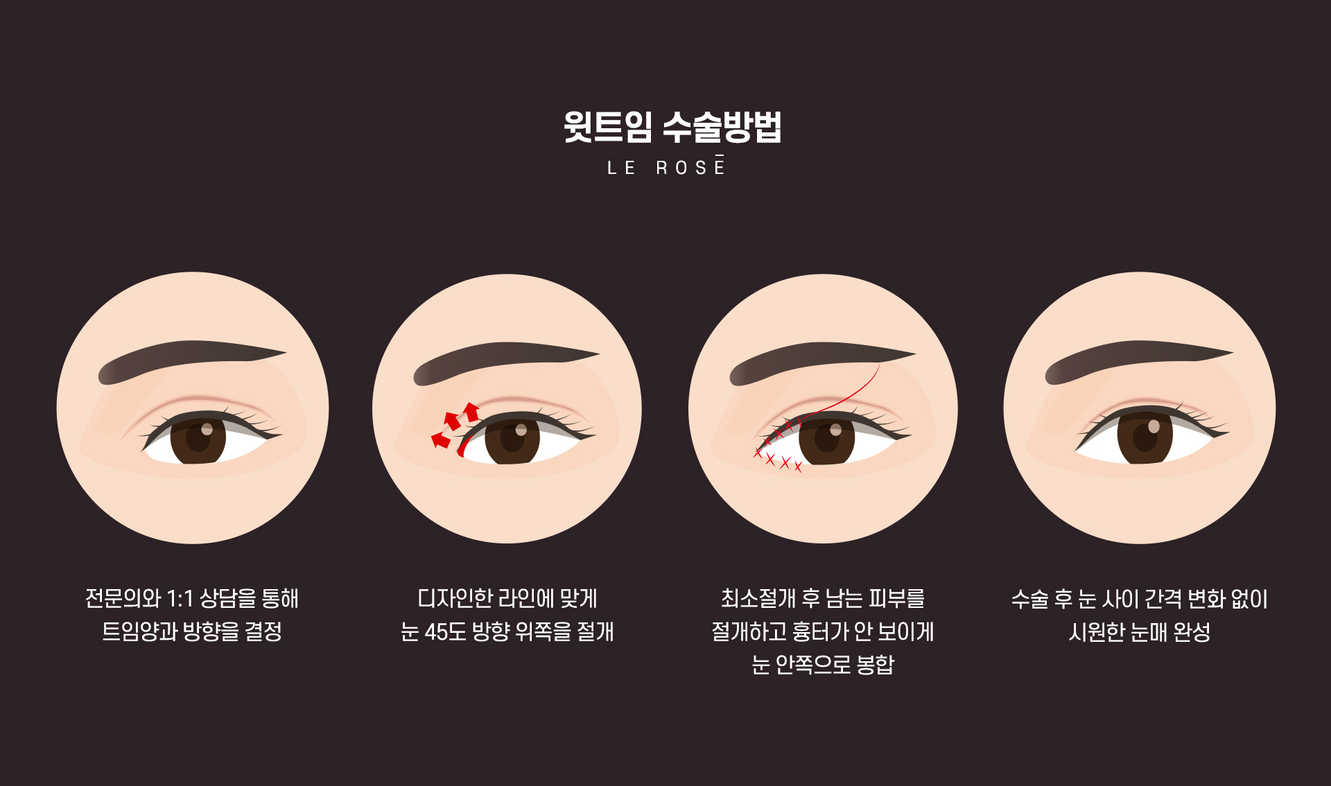 트임성형 윗트임수술방법