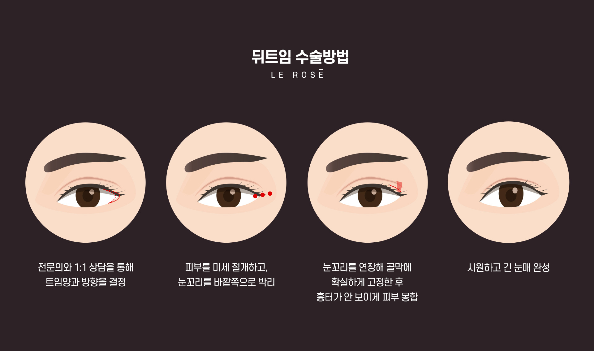 트임성형 뒤트임수술방법