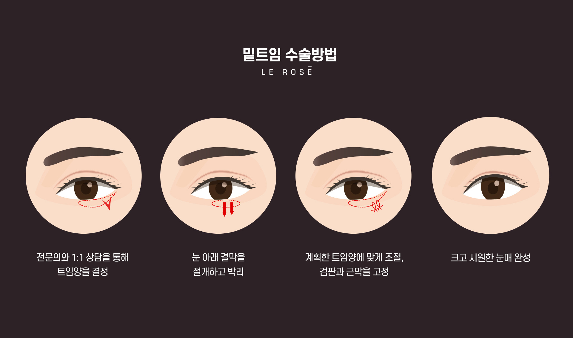 트임성형 밑트임수술방법