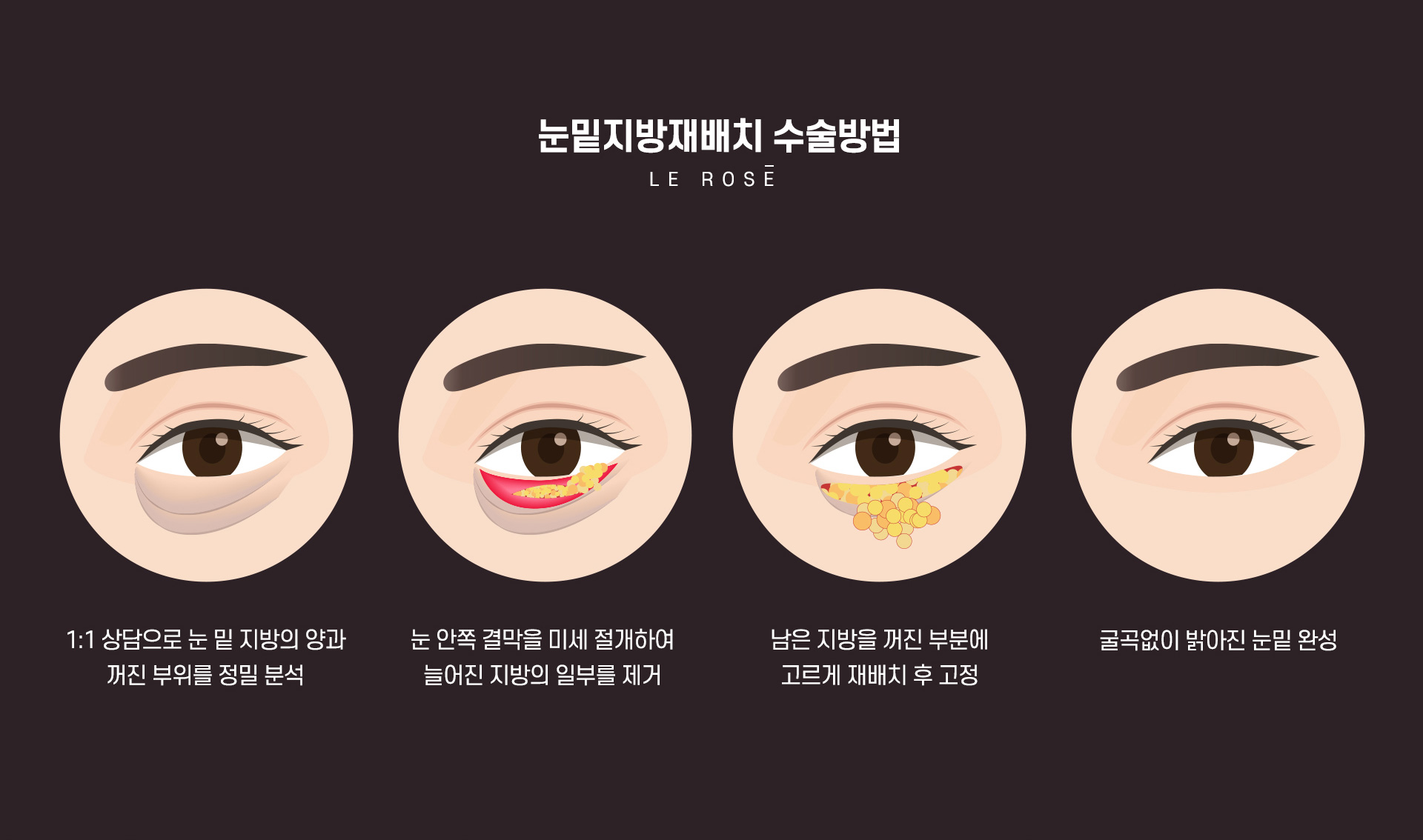 눈밑지방재배치 수술방법
