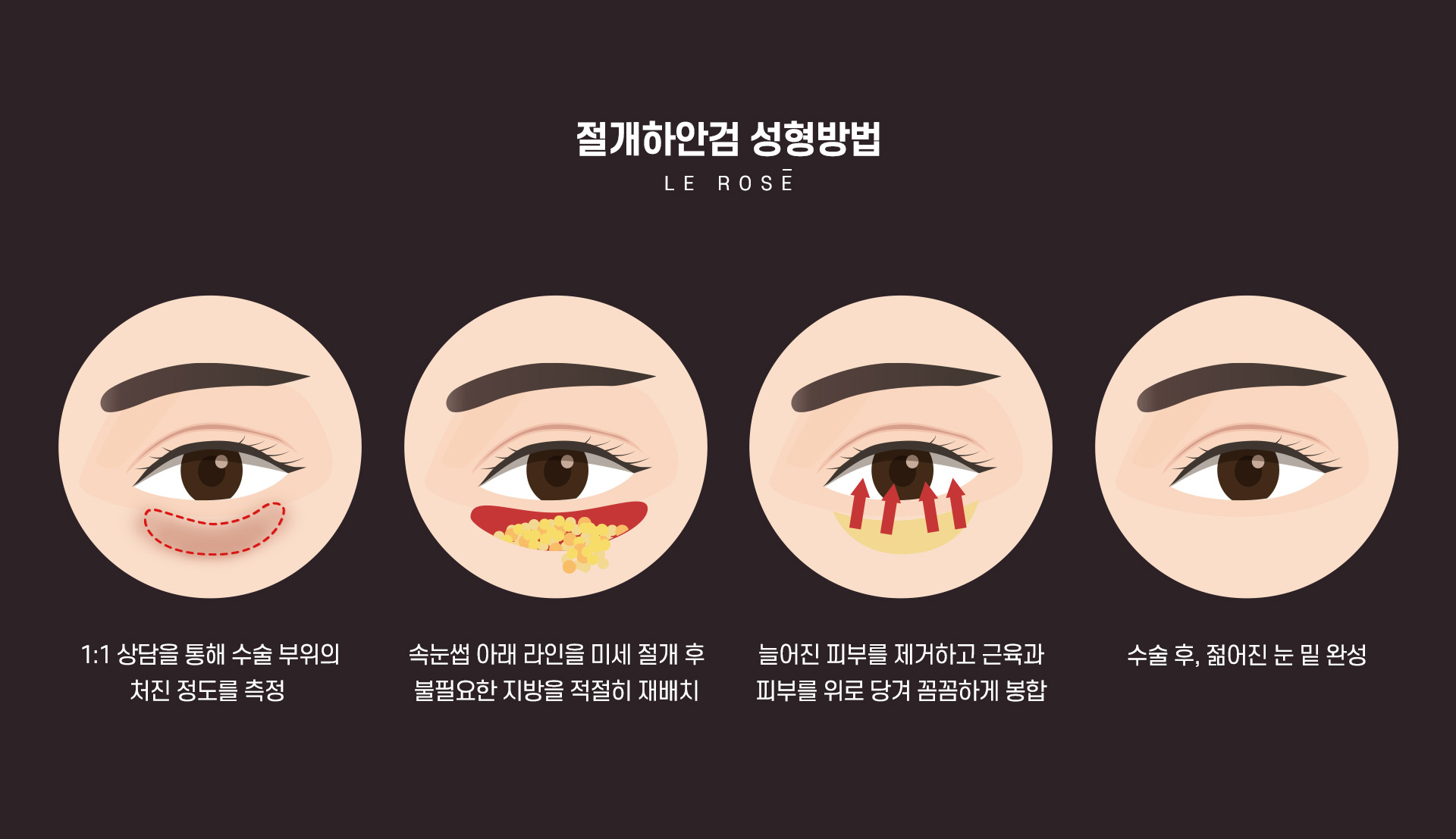 하안검성형 수술방법