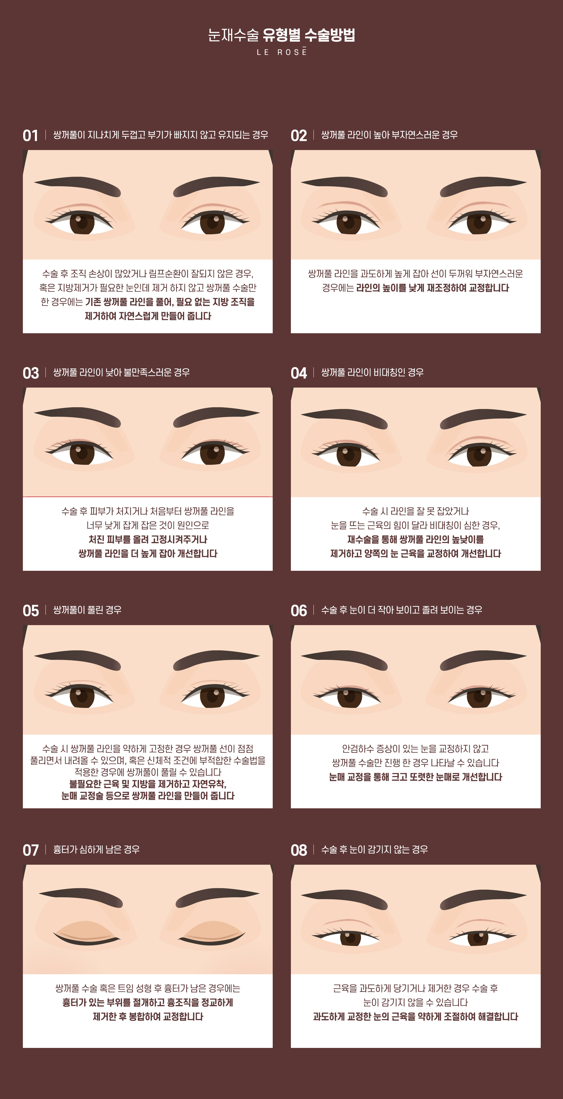 눈재수술 수술방법
